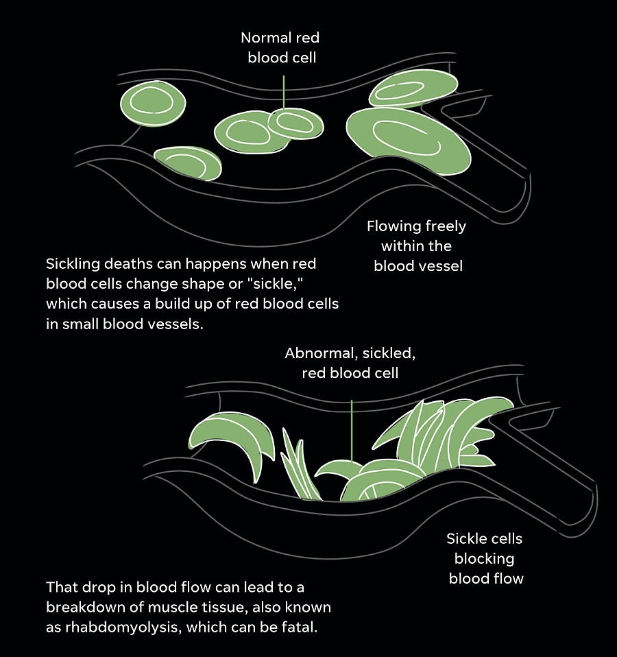 Illustration comparing normal blood flow and blood flow with abnormal, sickled red blood cells.